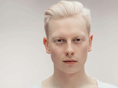 Genetika Langka Albino Terjadi Pada Manusia Atau Juga Hewan
