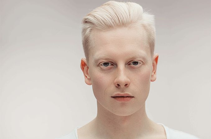 Genetika Langka Albino Terjadi Pada Manusia Atau Juga Hewan