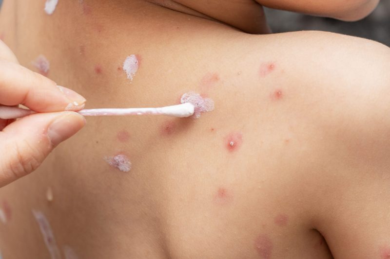 Varicella Zoster Atau Cacar Air Penyakit Virut Herpes