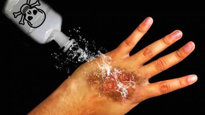 Cairan Kimia Air Keras Di Lakukan Untuk Hal Negatif