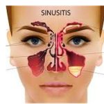 Peradangan Sinusitis Pada Penumpukan Lendir