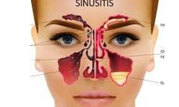 Peradangan Sinusitis Pada Penumpukan Lendir