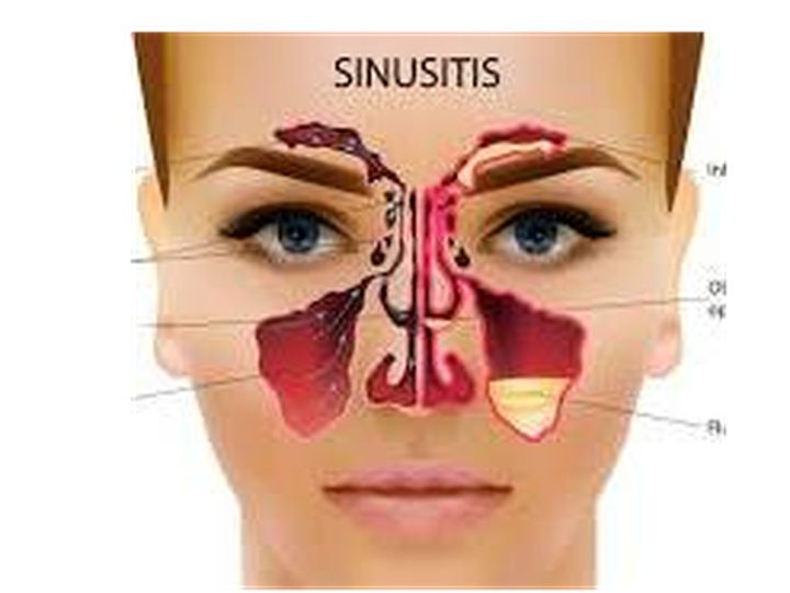 Peradangan Sinusitis Pada Penumpukan Lendir