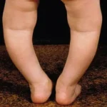 Penyebab Kaki X & O: Bukan Cuma Keturunan, Tapi Vitamin D