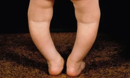 Penyebab Kaki X & O: Bukan Cuma Keturunan, Tapi Vitamin D