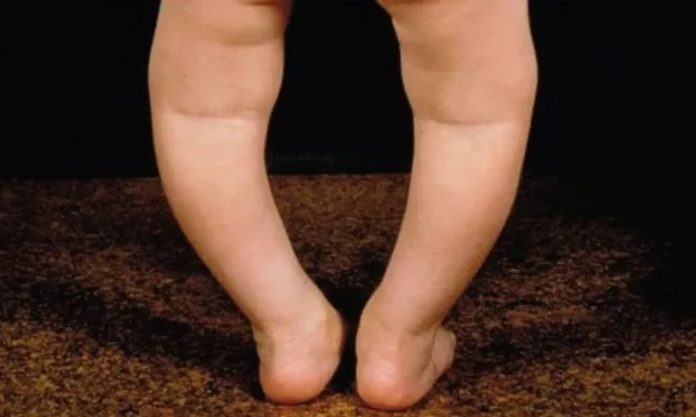 Penyebab Kaki X & O: Bukan Cuma Keturunan, Tapi Vitamin D