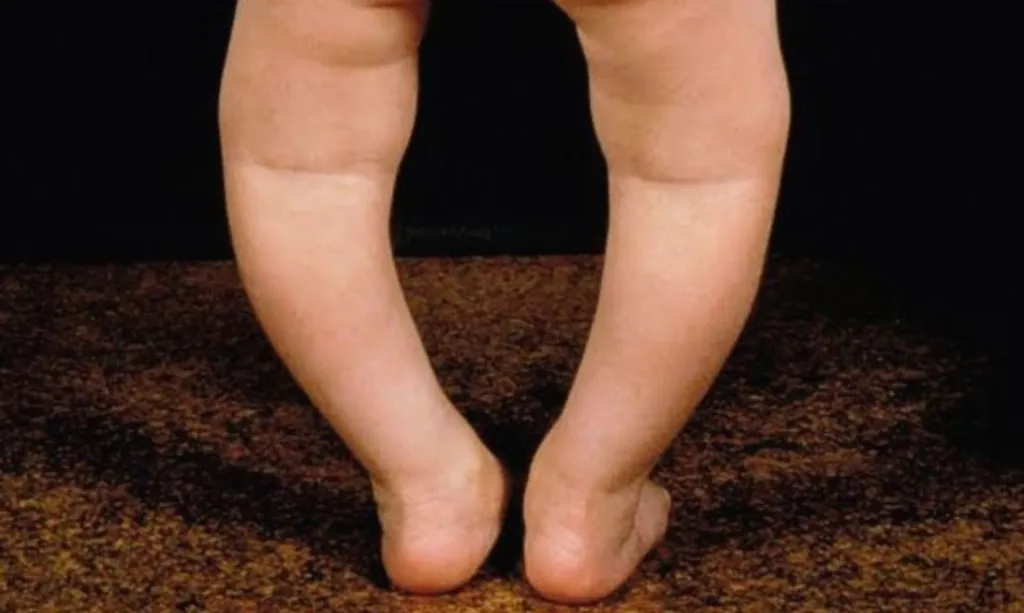 Penyebab Kaki X & O: Bukan Cuma Keturunan, Tapi Vitamin D